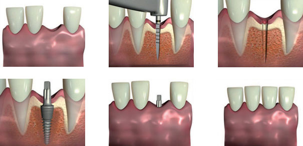 Minimalinvasive-Implantation