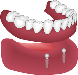 Implantatprothese auf Kugelankern