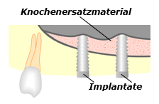 Sinuslift, der mit Knochersatzmaterial aufgebaute Kieferknochen bietet ausreichend Platz für die Implantate