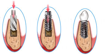 Veranschaulichung der Implantation