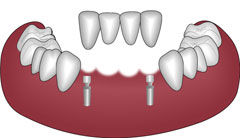 viergliedrige Implantatbrücke zum Ersatz der 4 unteren Frontzähne